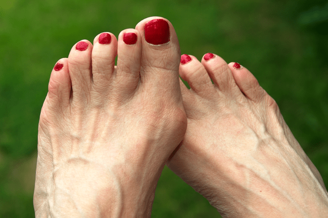 Do you have a large bump jutting out at the base of your big toe?